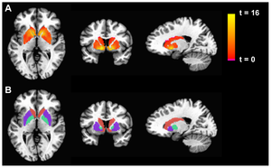 Brain-scan-CFS-basal-ganglia.png