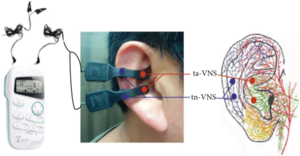 Ear with crocodile crips attaching electrodes to the auricular concha part of the ear for vagus nerve stimulation