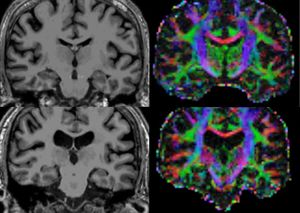 ME-CFS Brain Images.jpg