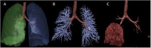 Computer-aided identification of lesions on the lungs of COVID-19 patients.