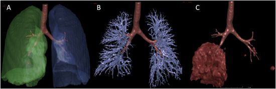 Computer-aided identification of lesions on the lungs of COVID-19 patients.